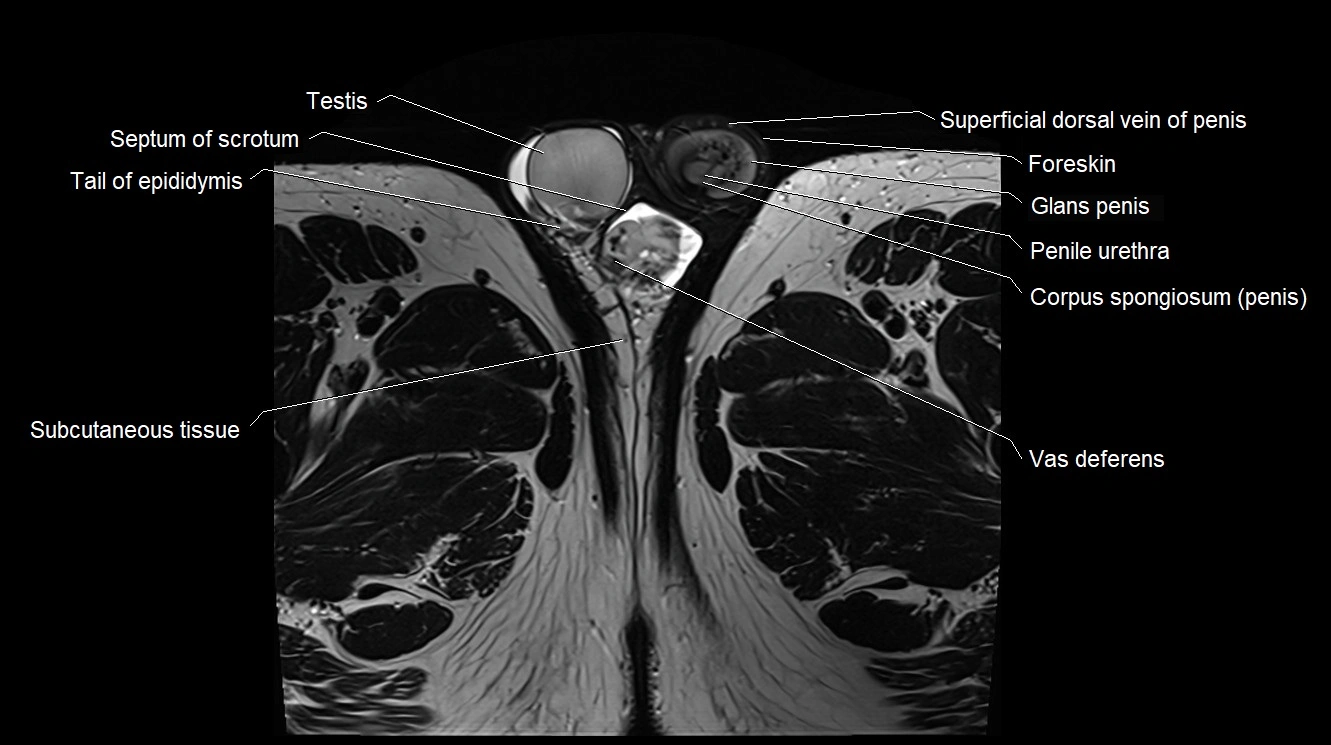 MRI 3T scrotum and penis axial cross sectional anatomy image 31.webp